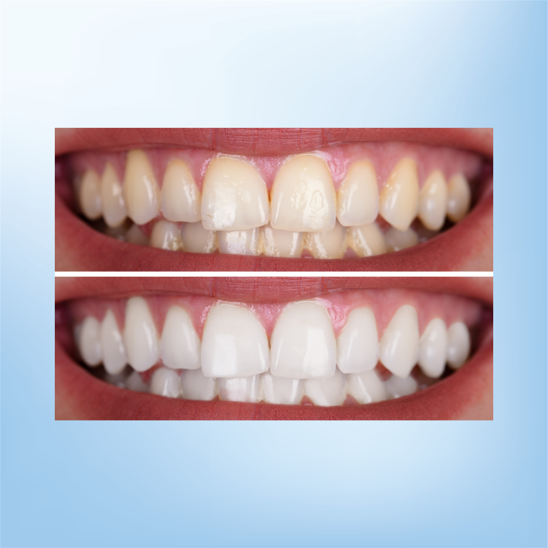 Oral-B 3D Whitening Strips Luxe Advanced Seal