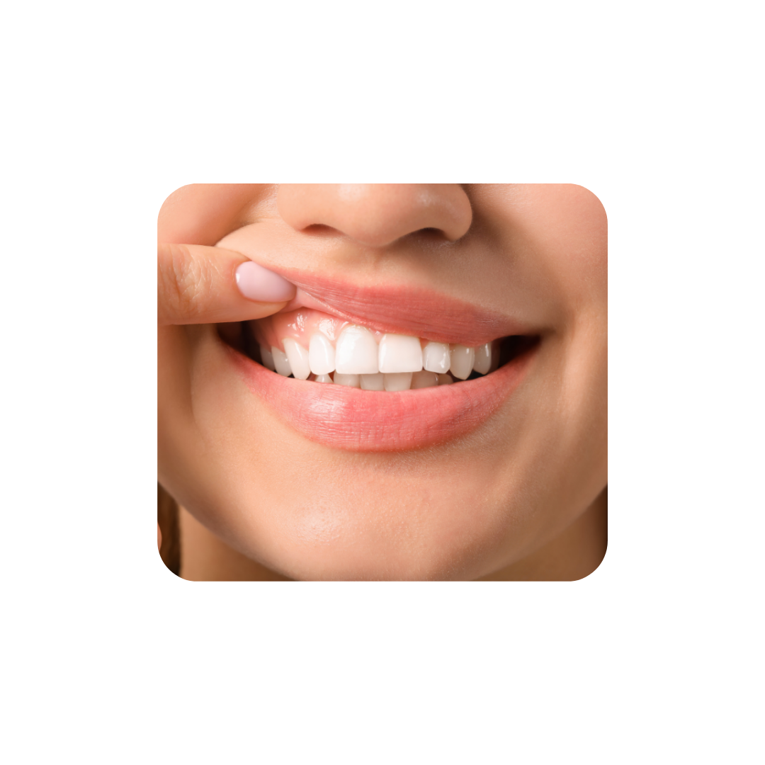 6x Vitis Whitening Zahnpasta – 75 ml